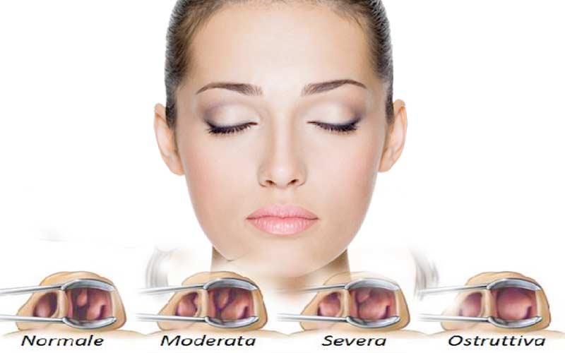 Tabique nasal desviado: causas, síntomas, consecuencias y remedios