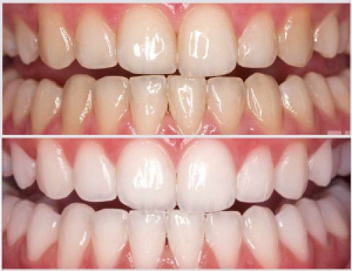 dientes antes y después del tratamiento con iA-Brush