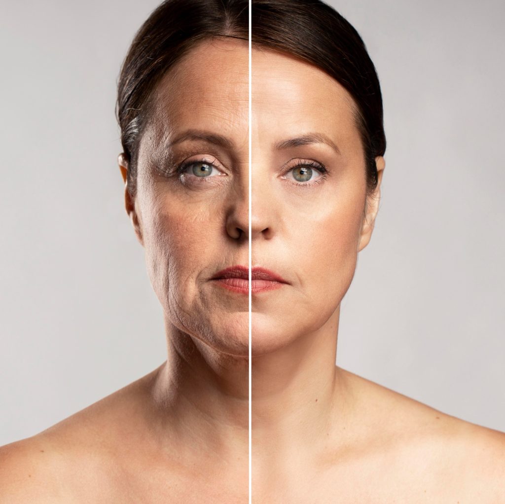 rostro de mujer con piel antes y después del tratamiento Fast Lifting